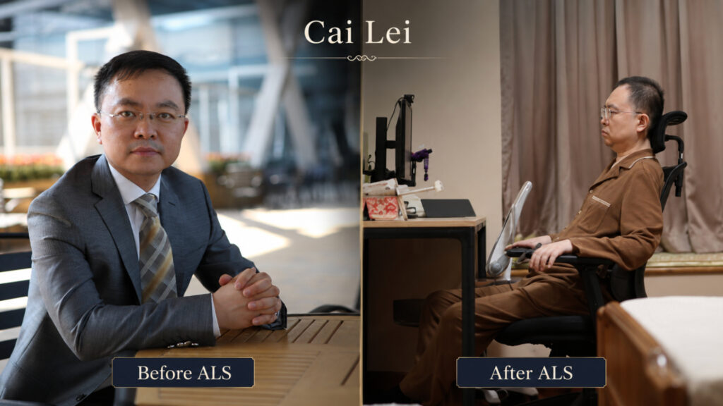 Cai Lei before and after ALS Mans International